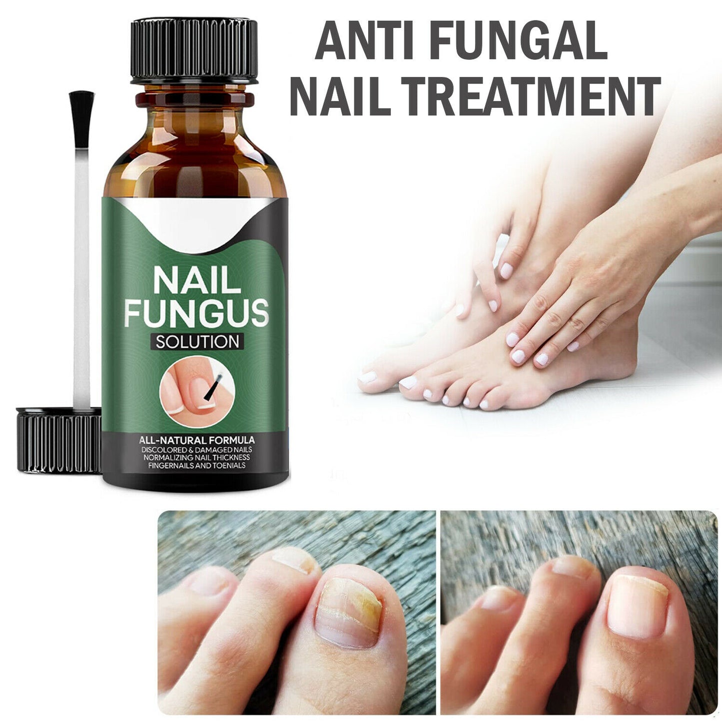 TJ Anti Fungal Nail Treatment Nail Finger Toe Fungus Onychomycosis Remover