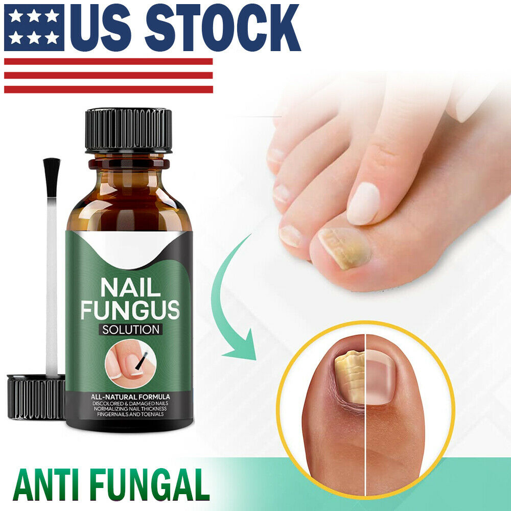 TJ Anti Fungal Nail Treatment Nail Finger Toe Fungus Onychomycosis Remover