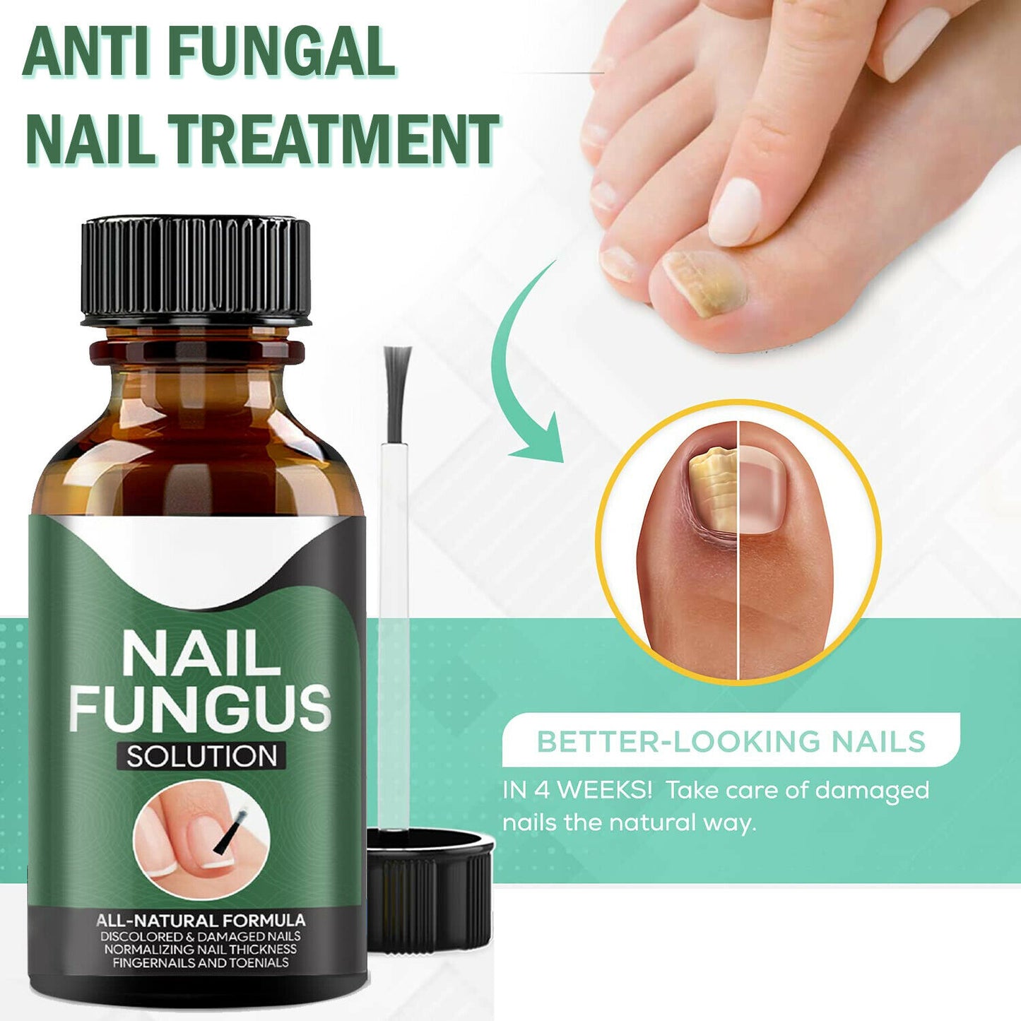 TJ Anti Fungal Nail Treatment Nail Finger Toe Fungus Onychomycosis Remover